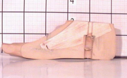 ��֫�׹ؽڵķ������������