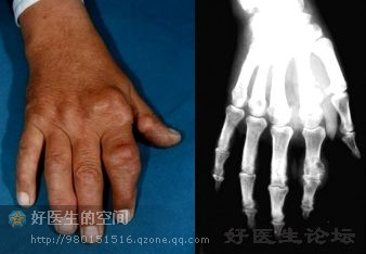 高尿酸血症与痛风